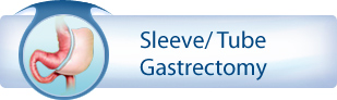 Sleeve/ Tube Gastrectomy